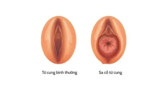 Sa tử cung: Dấu hiệu, mức độ và phương pháp điều trị
