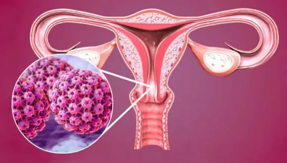 HPV và ung thư cổ tử cung: Tiêm phòng và tầm soát