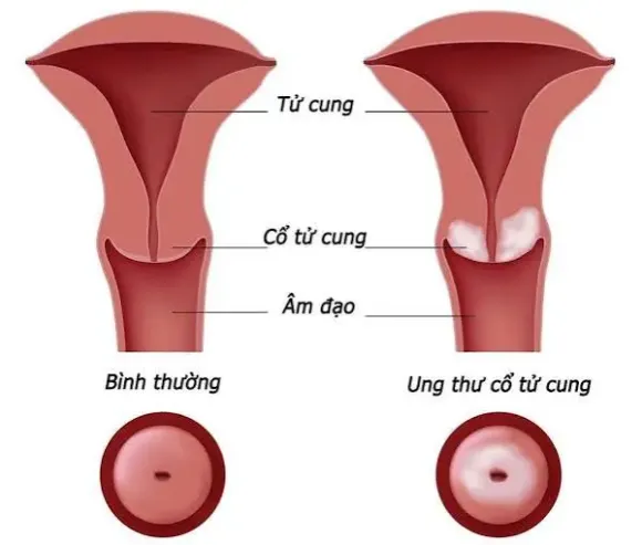 Điều trị ung thư cổ tử cung: Phẫu thuật hay hóa xạ trị?