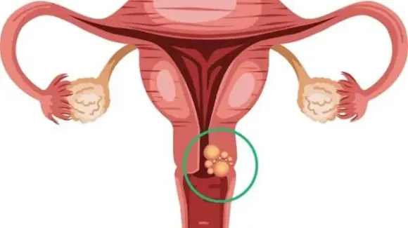 CIN 1, CIN 2, CIN 3: Có phải ung thư cổ tử cung?