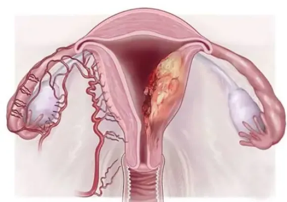 Điều trị ung thư nội mạc tử cung: Những điều cần biết