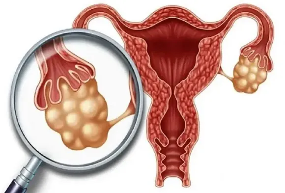 Ung thư buồng trứng có di truyền không? Vai trò BRCA