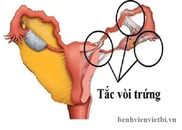 Tắc vòi trứng: Nguyên nhân thường gặp gây vô sinh ở nữ giới và cách điều trị